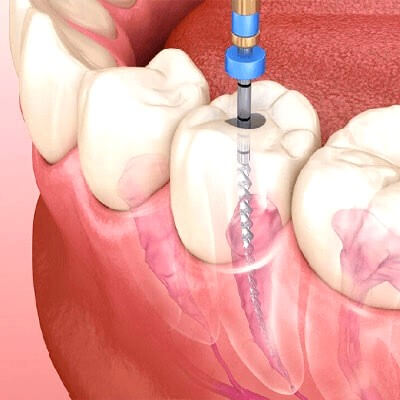 endodontia